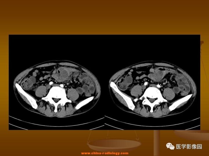 【病例】结肠粘液腺癌1例CT影像表现