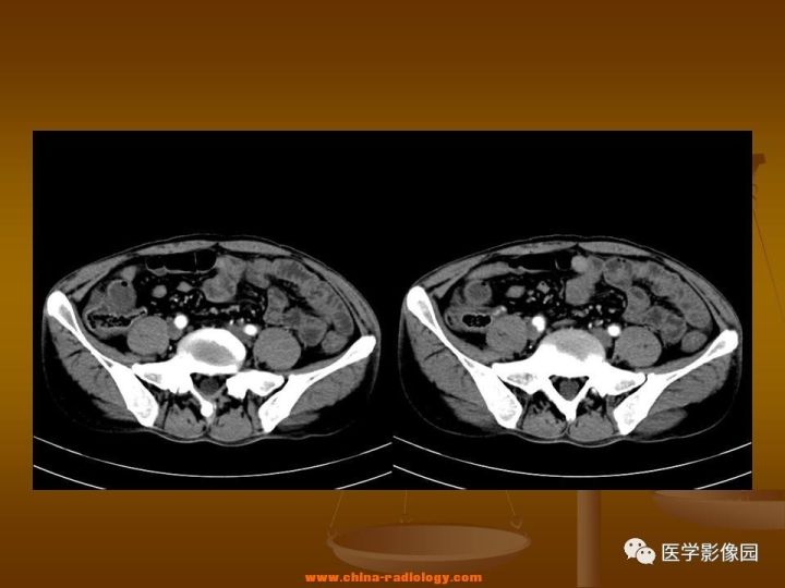 【病例】结肠粘液腺癌1例CT影像表现