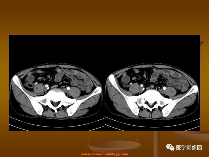 【病例】结肠粘液腺癌1例CT影像表现