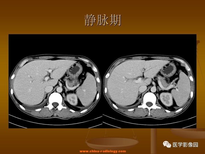 【病例】结肠粘液腺癌1例CT影像表现