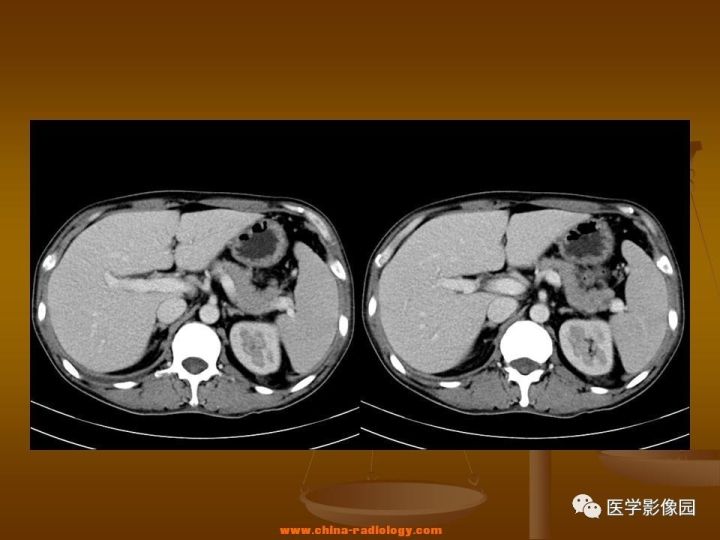【病例】结肠粘液腺癌1例CT影像表现
