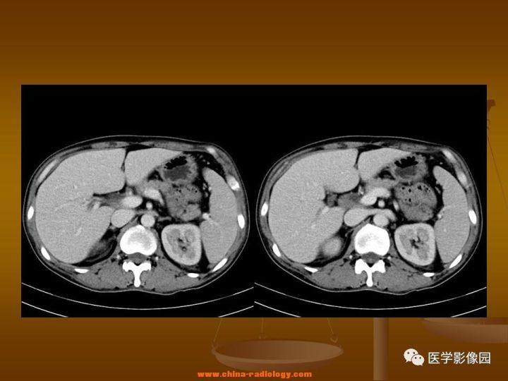 【病例】结肠粘液腺癌1例CT影像表现