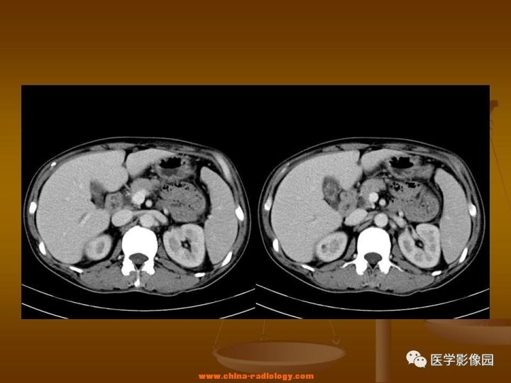 【病例】结肠粘液腺癌1例CT影像表现