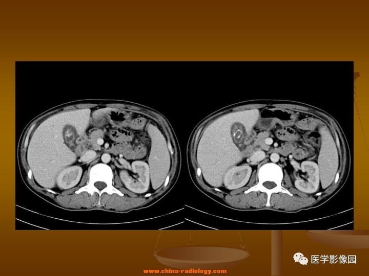 【病例】结肠粘液腺癌1例CT影像表现