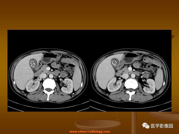 【病例】结肠粘液腺癌1例CT影像表现