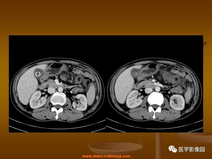 【病例】结肠粘液腺癌1例CT影像表现
