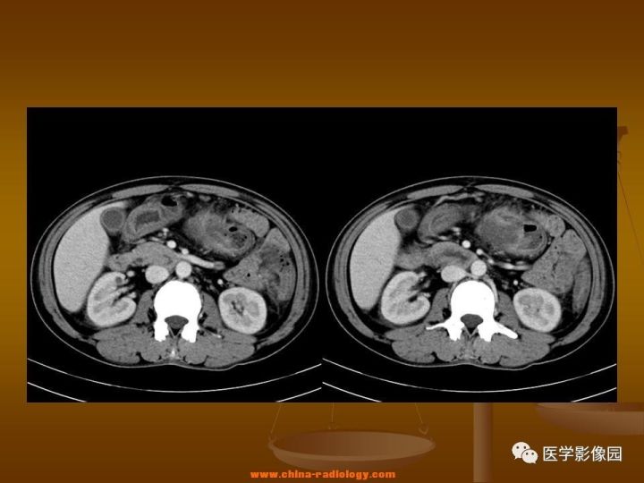 【病例】结肠粘液腺癌1例CT影像表现