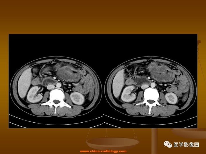 【病例】结肠粘液腺癌1例CT影像表现