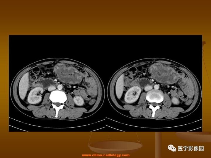 【病例】结肠粘液腺癌1例CT影像表现