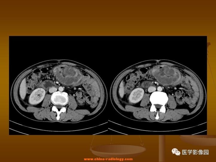 【病例】结肠粘液腺癌1例CT影像表现