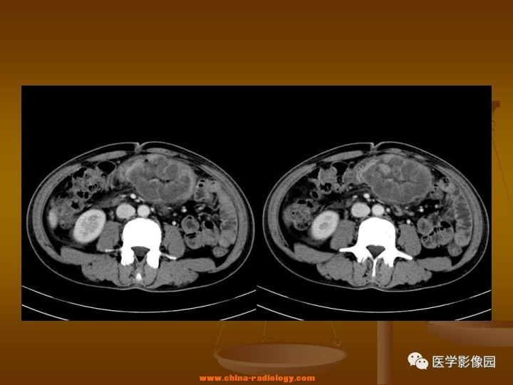【病例】结肠粘液腺癌1例CT影像表现