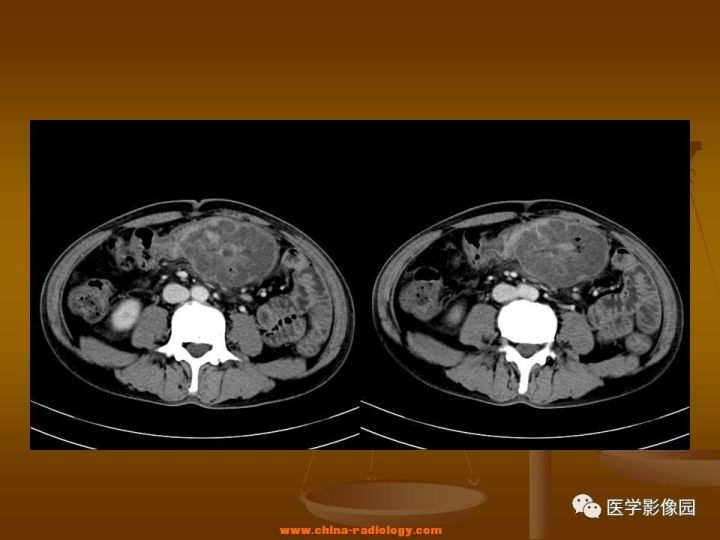 【病例】结肠粘液腺癌1例CT影像表现
