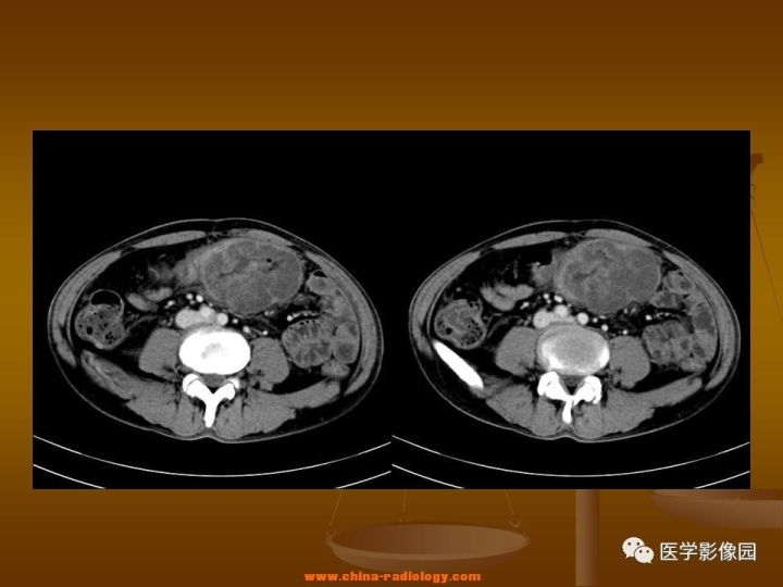 【病例】结肠粘液腺癌1例CT影像表现