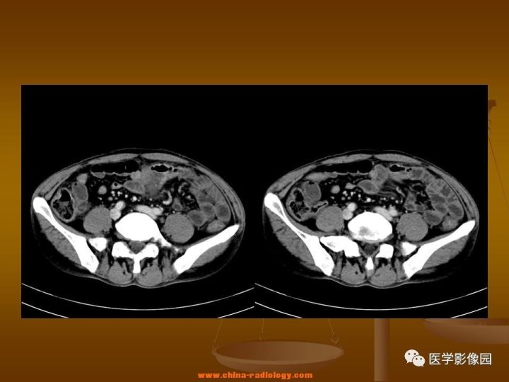 【病例】结肠粘液腺癌1例CT影像表现