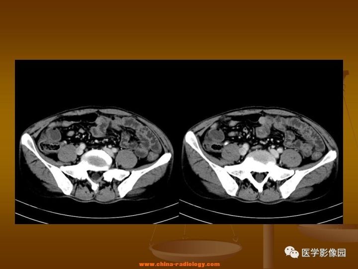 【病例】结肠粘液腺癌1例CT影像表现