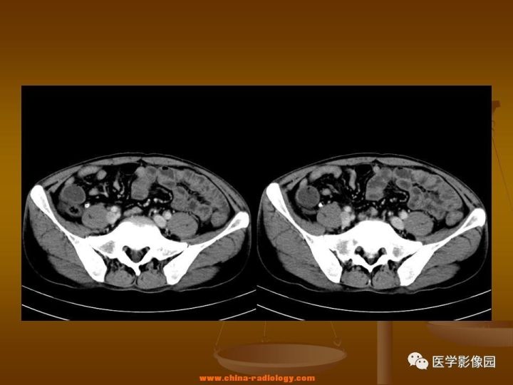 【病例】结肠粘液腺癌1例CT影像表现