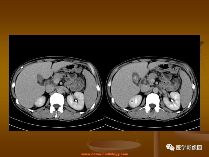 【病例】结肠粘液腺癌1例CT影像表现
