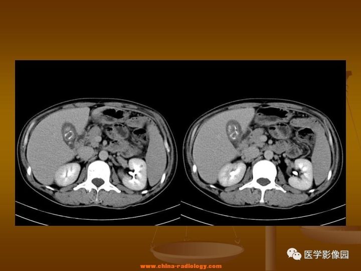 【病例】结肠粘液腺癌1例CT影像表现