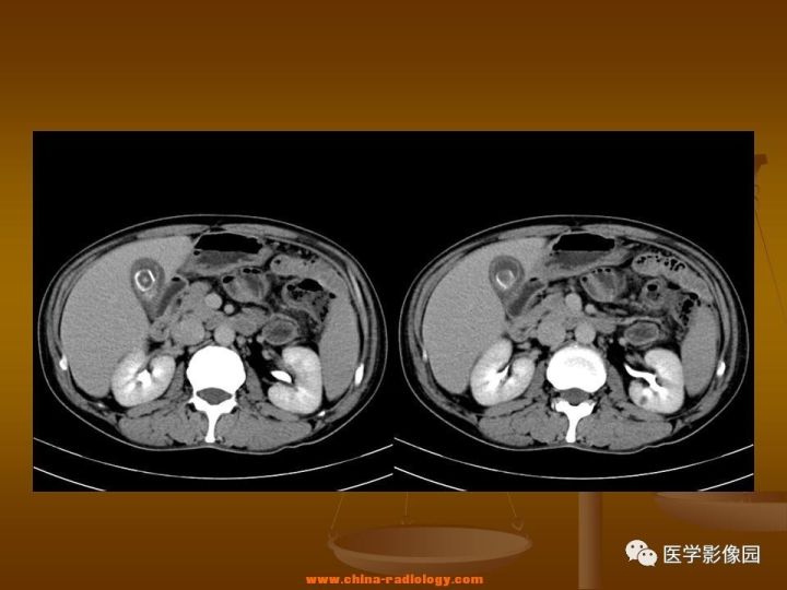 【病例】结肠粘液腺癌1例CT影像表现