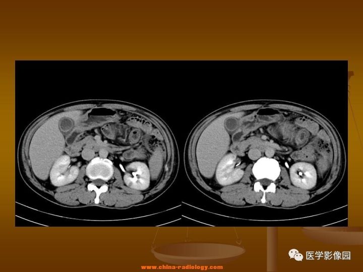 【病例】结肠粘液腺癌1例CT影像表现