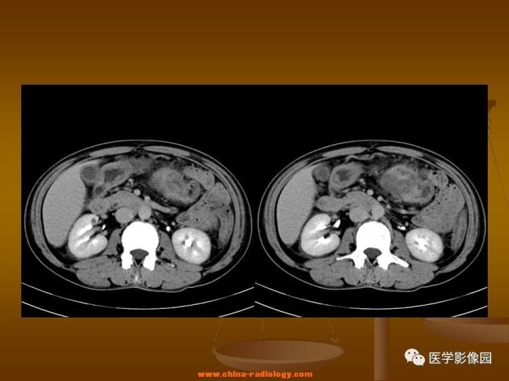 【病例】结肠粘液腺癌1例CT影像表现