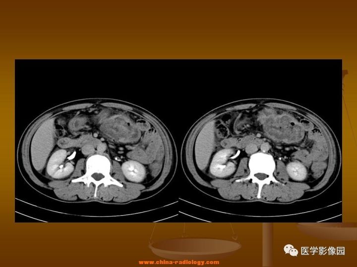 【病例】结肠粘液腺癌1例CT影像表现