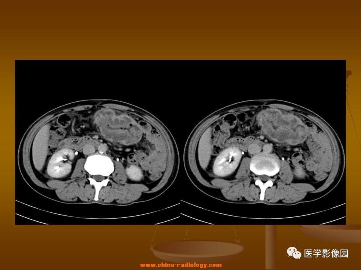 【病例】结肠粘液腺癌1例CT影像表现