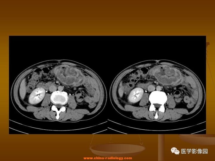 【病例】结肠粘液腺癌1例CT影像表现