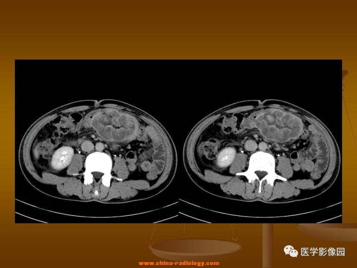 【病例】结肠粘液腺癌1例CT影像表现