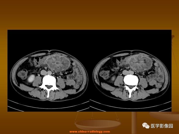 【病例】结肠粘液腺癌1例CT影像表现