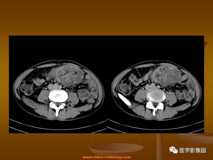 【病例】结肠粘液腺癌1例CT影像表现