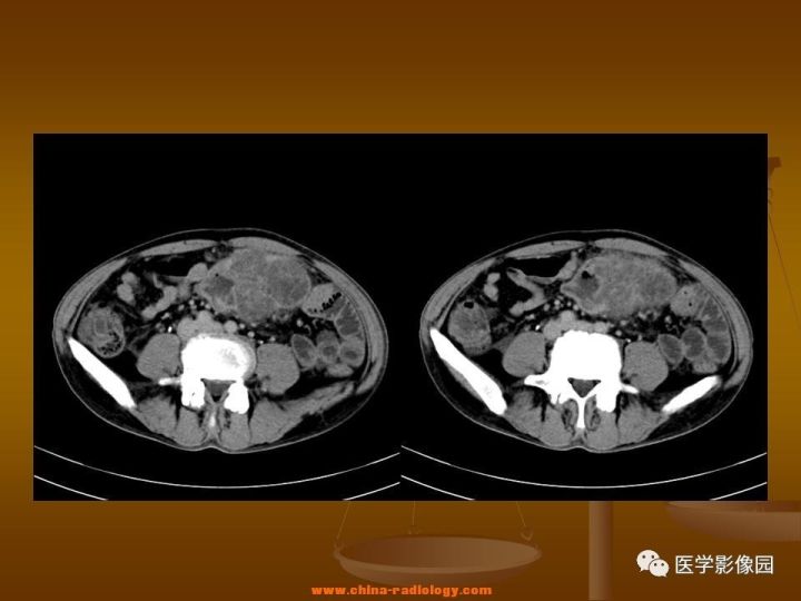 【病例】结肠粘液腺癌1例CT影像表现