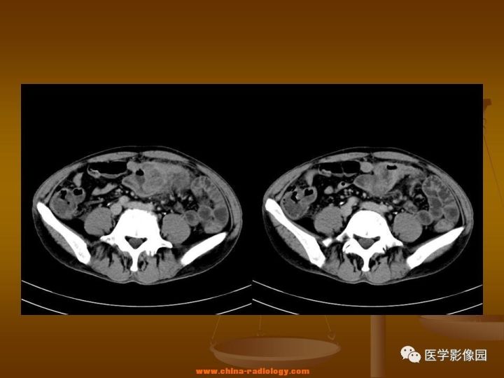 【病例】结肠粘液腺癌1例CT影像表现