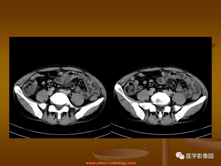 【病例】结肠粘液腺癌1例CT影像表现