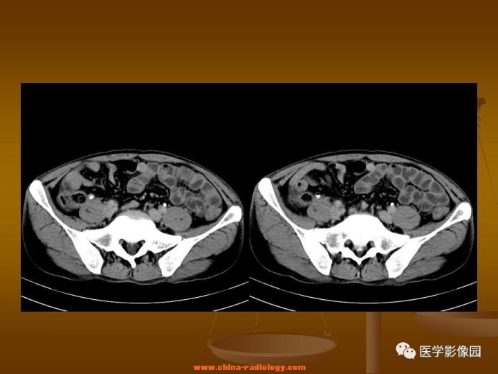 【病例】结肠粘液腺癌1例CT影像表现