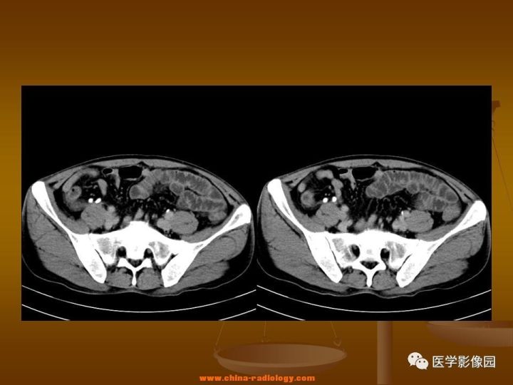 【病例】结肠粘液腺癌1例CT影像表现