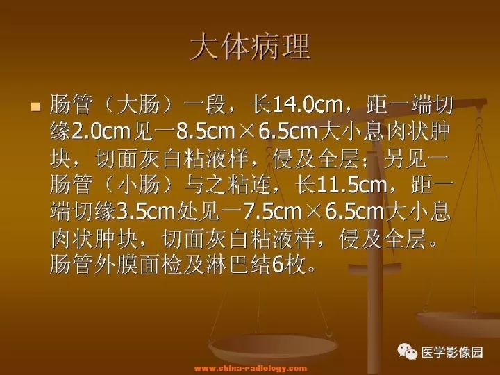 【病例】结肠粘液腺癌1例CT影像表现