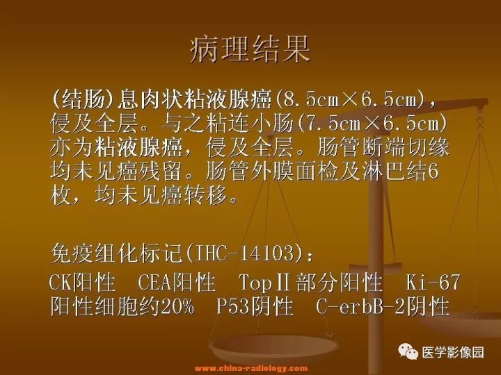 【病例】结肠粘液腺癌1例CT影像表现