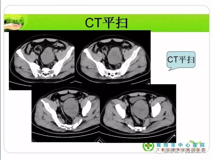 【病例】盆腔恶性血管周细胞瘤(外皮细胞瘤)1例