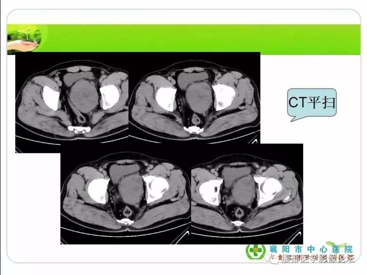 【病例】盆腔恶性血管周细胞瘤(外皮细胞瘤)1例
