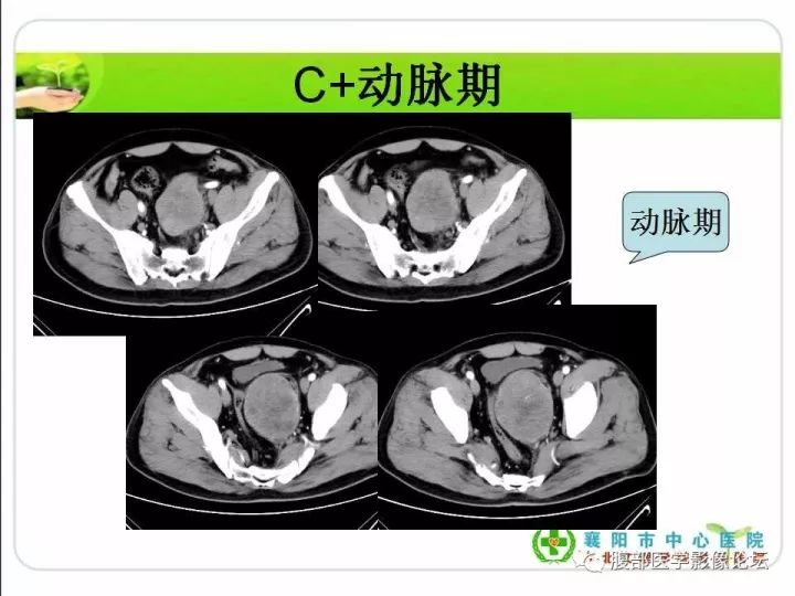 【病例】盆腔恶性血管周细胞瘤(外皮细胞瘤)1例