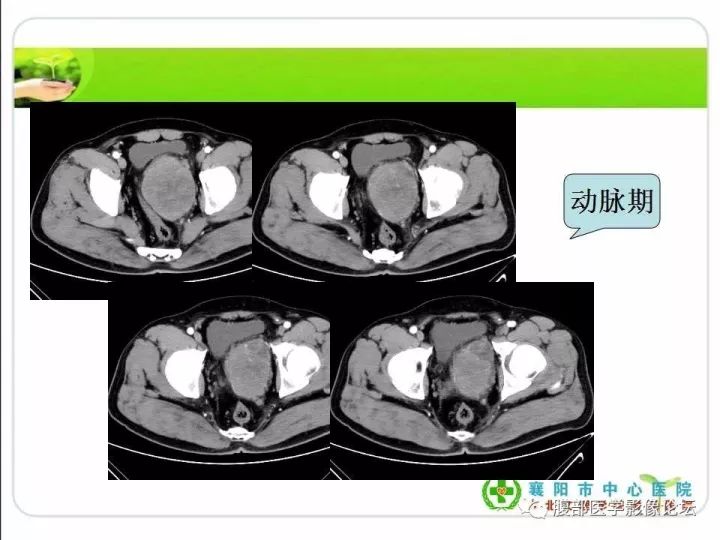 【病例】盆腔恶性血管周细胞瘤(外皮细胞瘤)1例