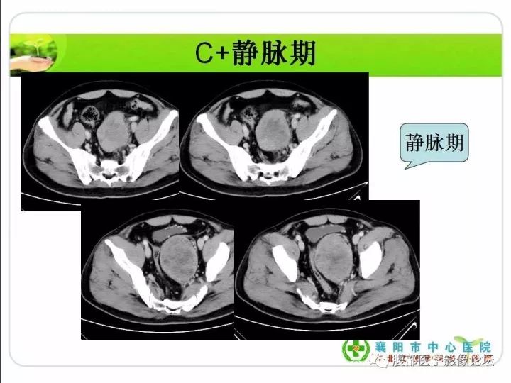 【病例】盆腔恶性血管周细胞瘤(外皮细胞瘤)1例
