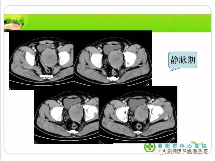 【病例】盆腔恶性血管周细胞瘤(外皮细胞瘤)1例