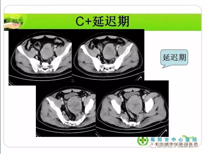 【病例】盆腔恶性血管周细胞瘤(外皮细胞瘤)1例
