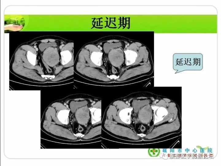 【病例】盆腔恶性血管周细胞瘤(外皮细胞瘤)1例