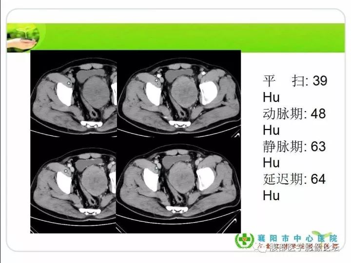 【病例】盆腔恶性血管周细胞瘤(外皮细胞瘤)1例