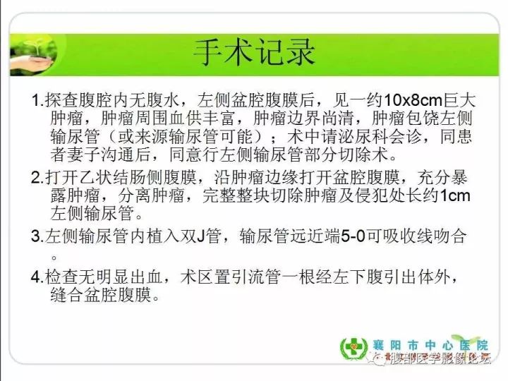 【病例】盆腔恶性血管周细胞瘤(外皮细胞瘤)1例