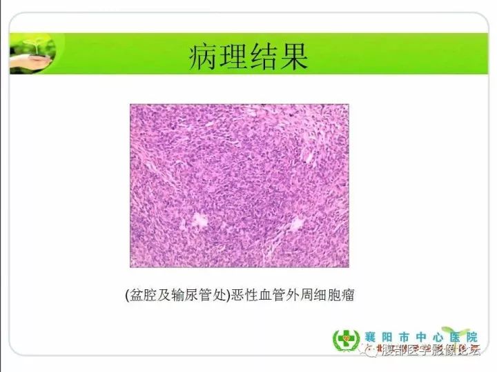 【病例】盆腔恶性血管周细胞瘤(外皮细胞瘤)1例