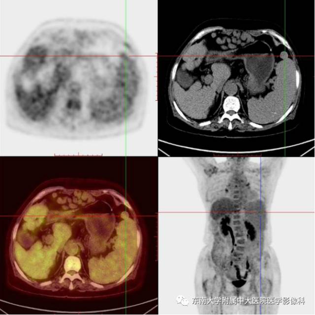 【病例】脾脏肿大两例PET/CT影像诊断与鉴别